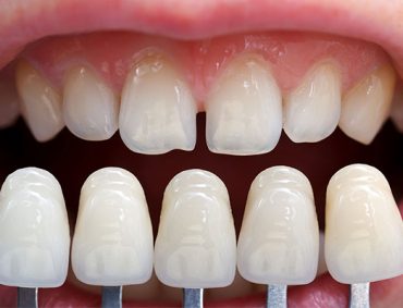 What-Are-Dental-Laminates What-Are-Dental-Laminates