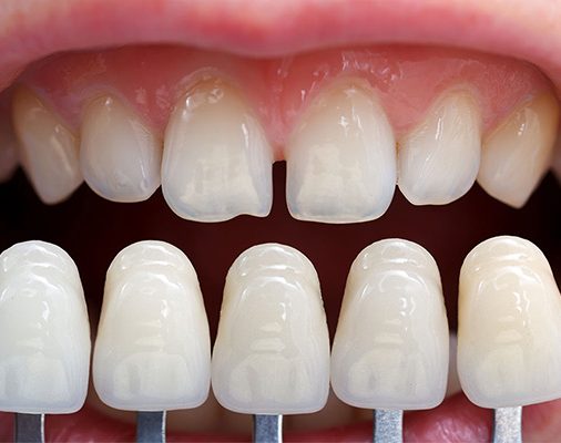 What-Are-Dental-Laminates What-Are-Dental-Laminates