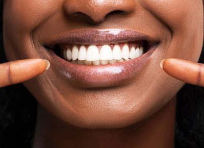 teeth-whitening-2 teeth-whitening-2